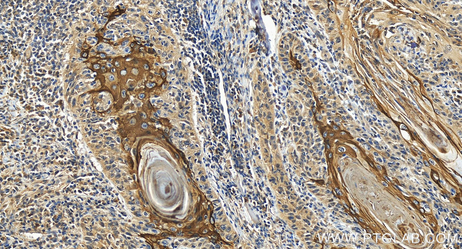 Immunohistochemistry (IHC) staining of human skin cancer tissue using Cytokeratin 10-specific Polyclonal antibody (16855-1-AP)