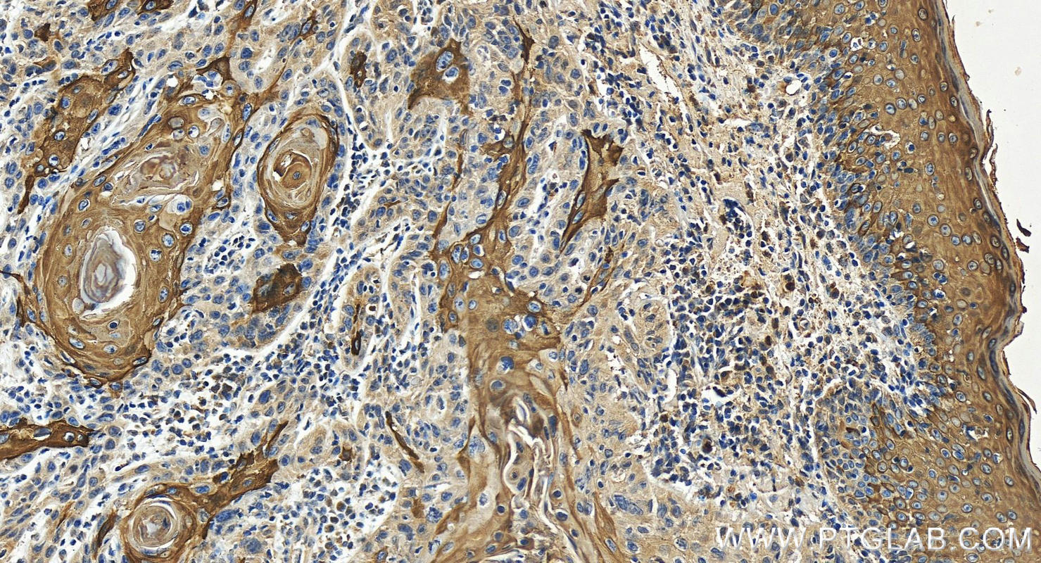 Immunohistochemistry (IHC) staining of human skin cancer tissue using Cytokeratin 10-specific Polyclonal antibody (16855-1-AP)