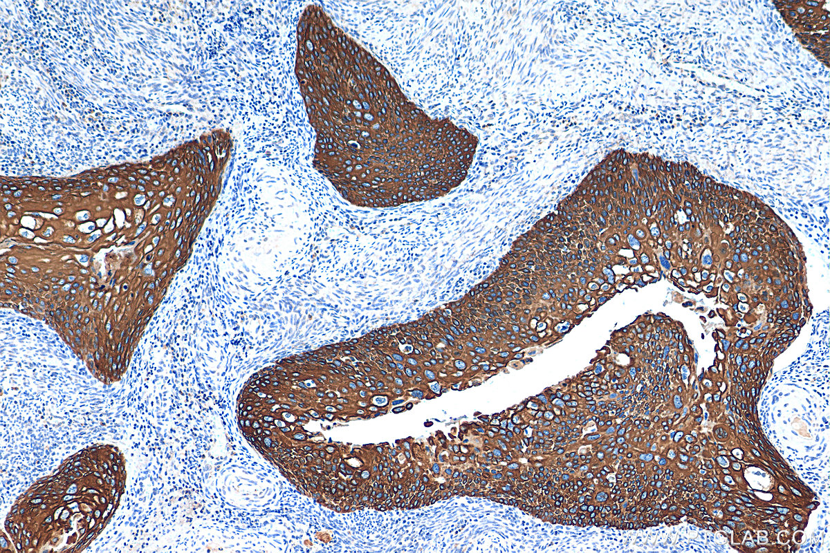 Immunohistochemistry (IHC) staining of human cervical cancer tissue using Cytokeratin 13 Monoclonal antibody (66684-1-Ig)