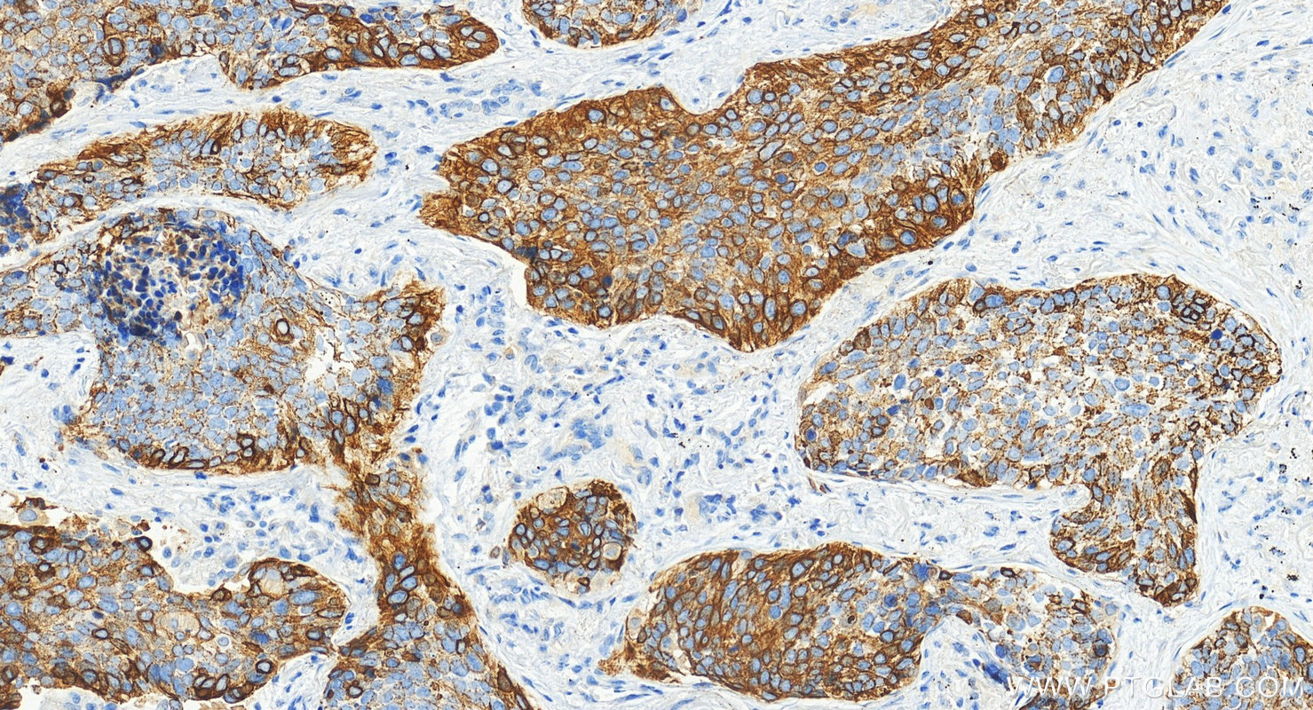 Immunohistochemistry (IHC) staining of human lung squamous cell carcinoma tissue using Cytokeratin 14 Polyclonal antibody (10143-1-AP)