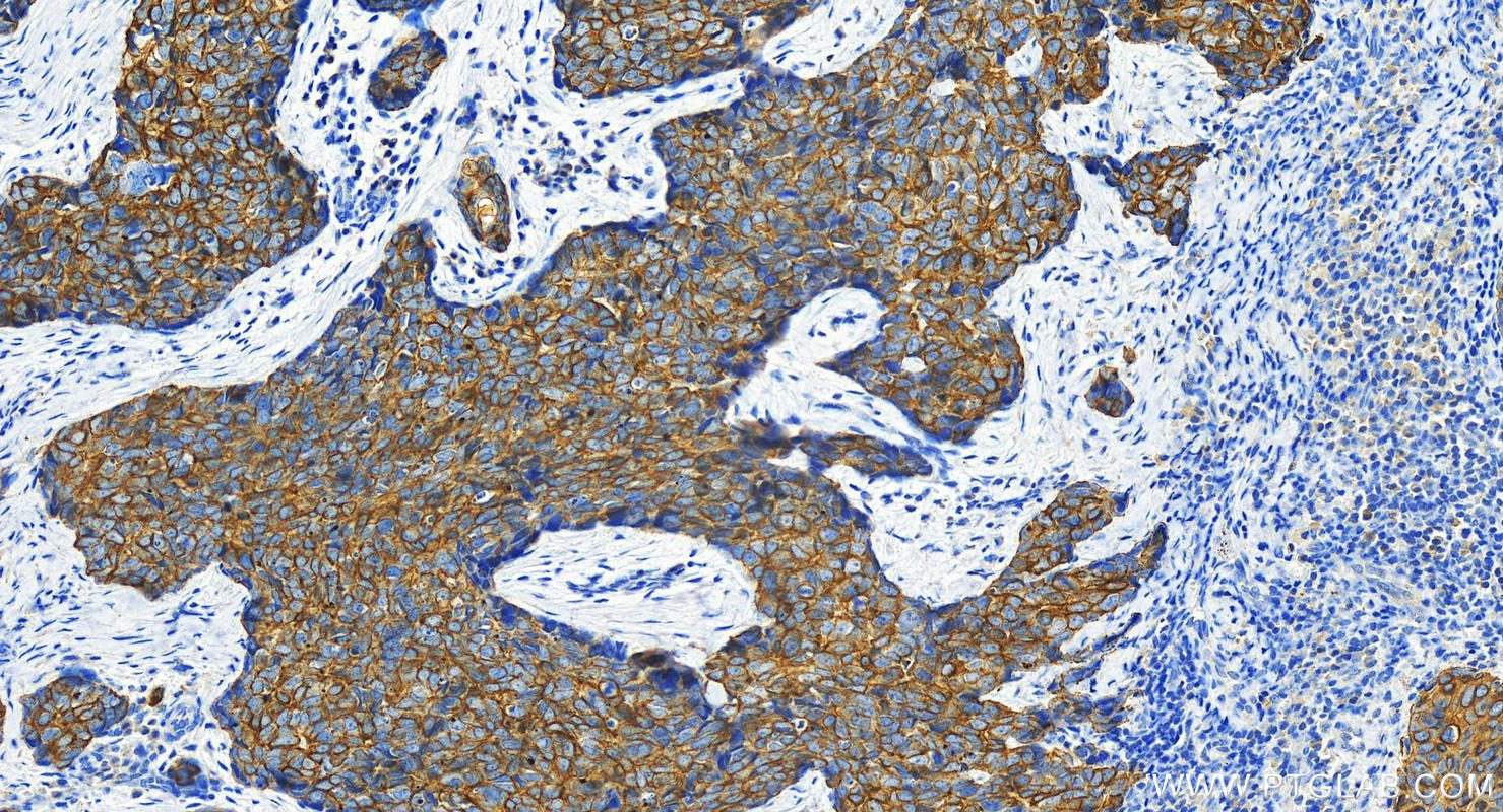 Immunohistochemistry (IHC) staining of human bowen disease using Cytokeratin 16 Polyclonal antibody (17265-1-AP)