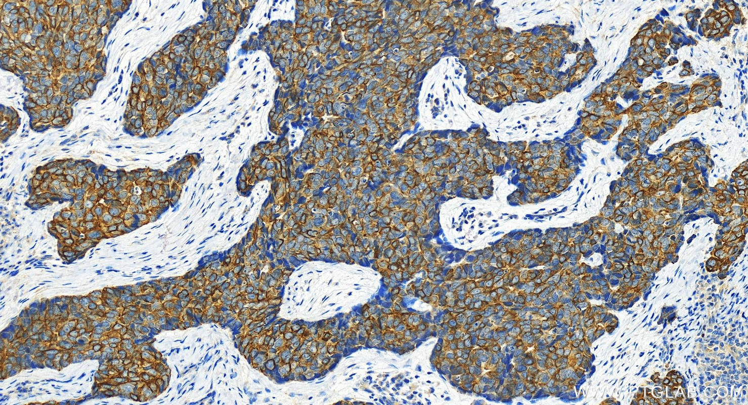 Immunohistochemistry (IHC) staining of human bowen disease using Cytokeratin 17 Polyclonal antibody (22230-1-AP)