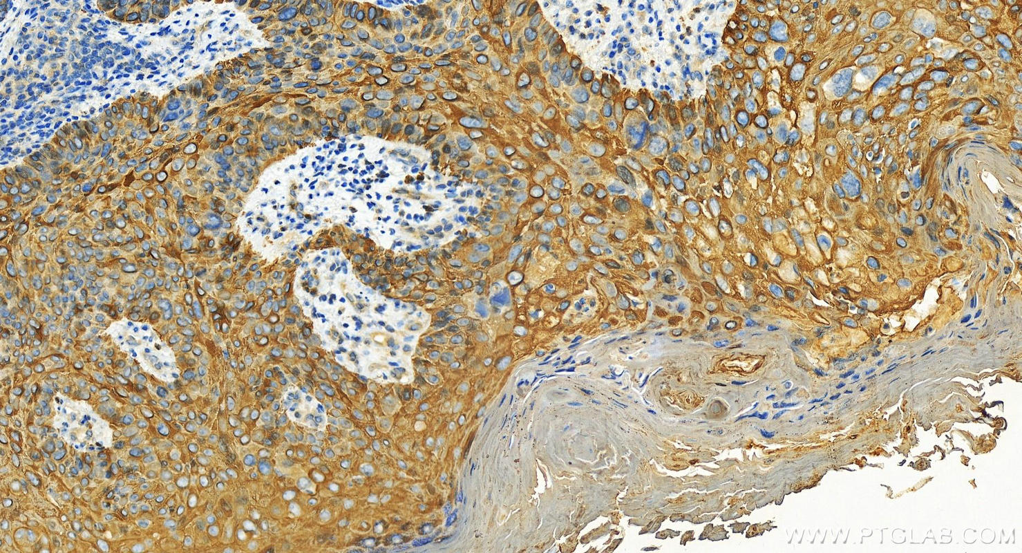 Immunohistochemistry (IHC) staining of human bowen disease using Cytokeratin 17 Polyclonal antibody (22230-1-AP)