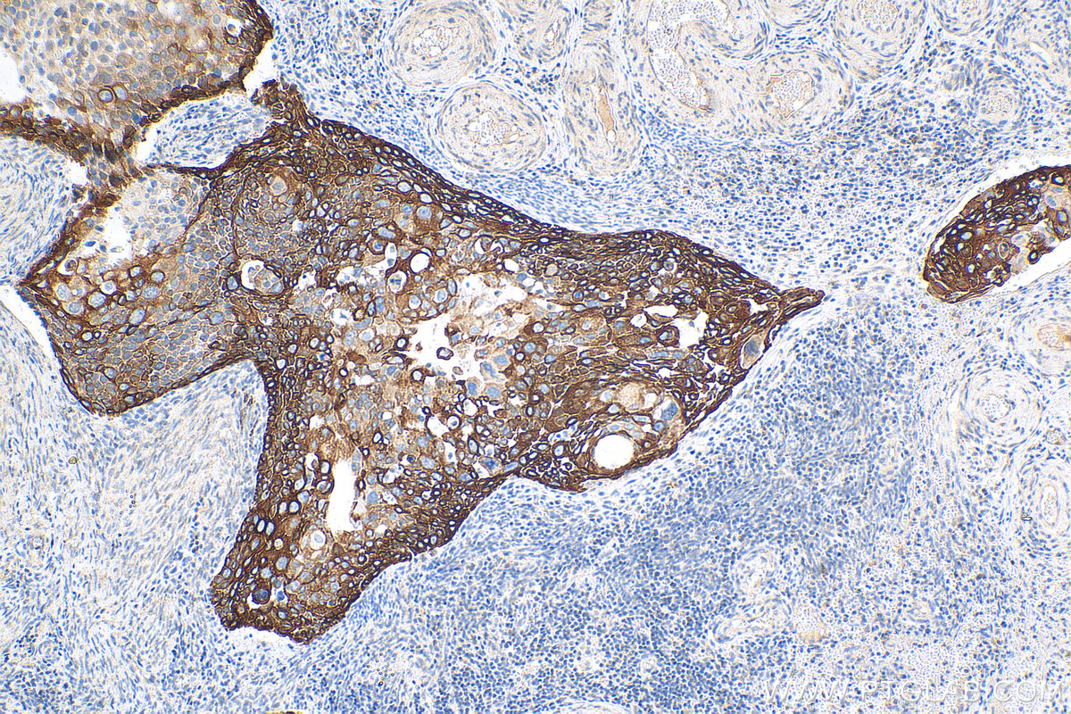 Immunohistochemistry (IHC) staining of human cervical cancer tissue using Cytokeratin 17-Specific Polyclonal antibody (17516-1-AP)