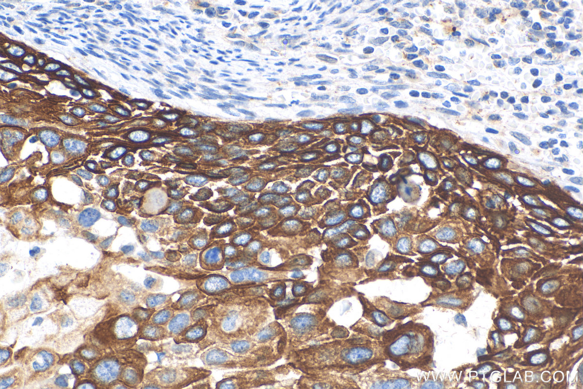 Immunohistochemistry (IHC) staining of human cervical cancer tissue using Cytokeratin 17-Specific Polyclonal antibody (17516-1-AP)