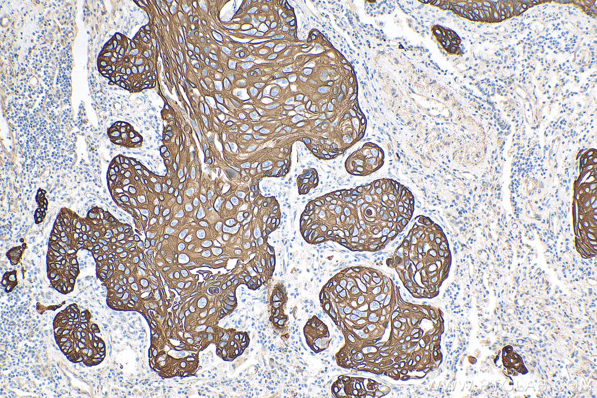 Immunohistochemistry (IHC) staining of human lung cancer tissue using Cytokeratin 17-Specific Polyclonal antibody (17516-1-AP)