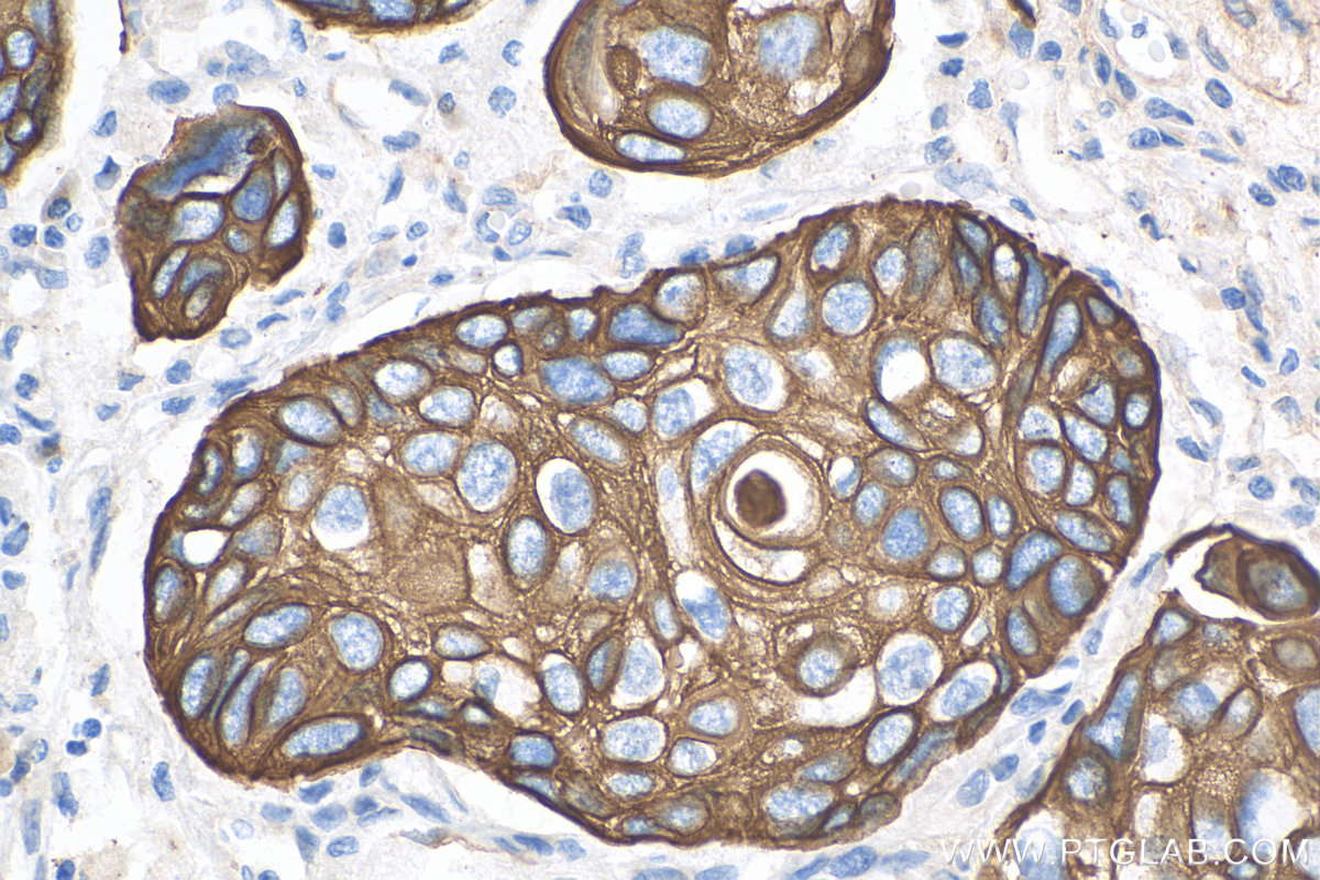 Immunohistochemistry (IHC) staining of human lung cancer tissue using Cytokeratin 17-Specific Polyclonal antibody (17516-1-AP)