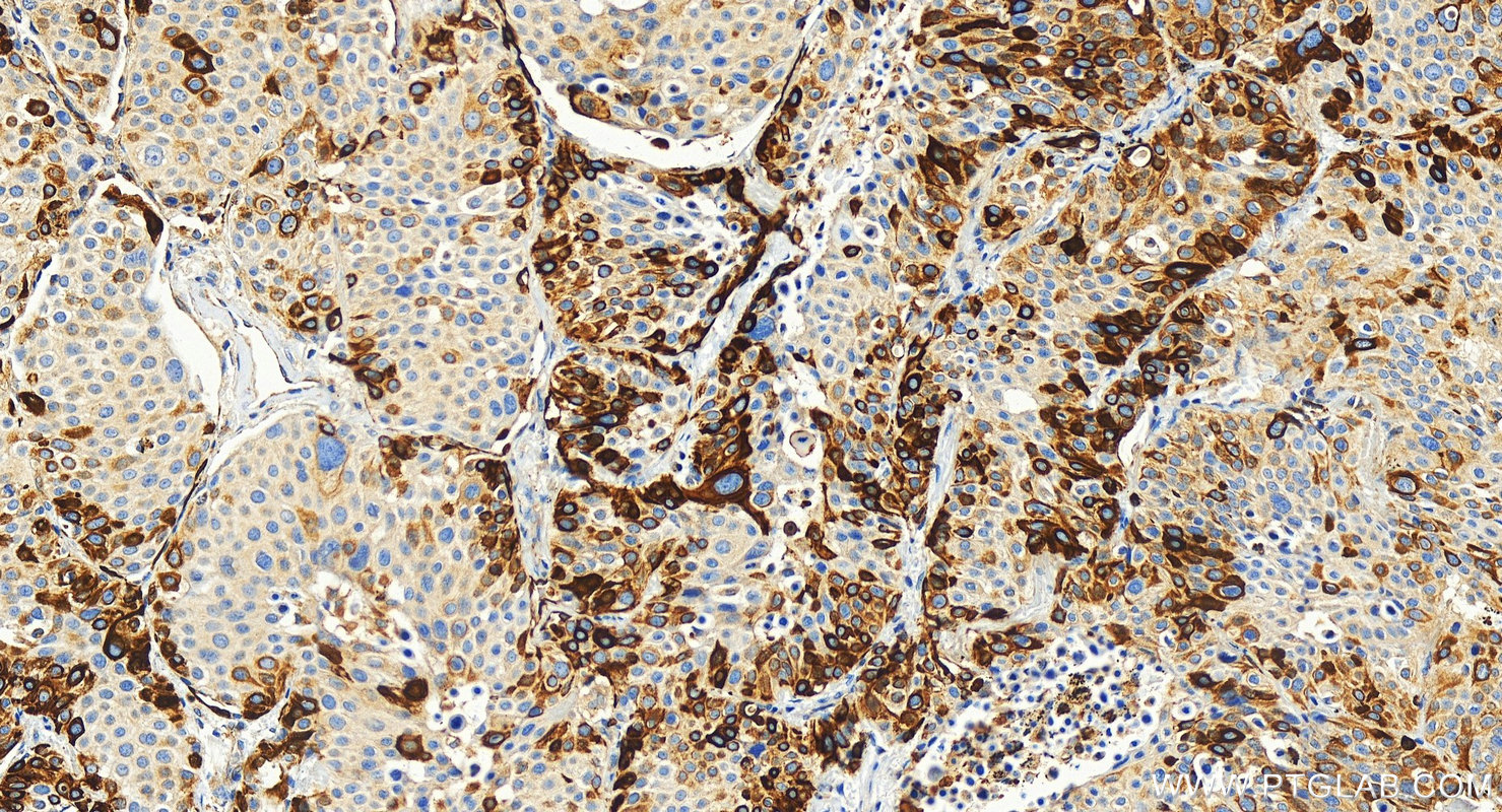 Immunohistochemistry (IHC) staining of human lung squamous cell carcinoma tissue using Cytokeratin 17-Specific Polyclonal antibody (17516-1-AP)