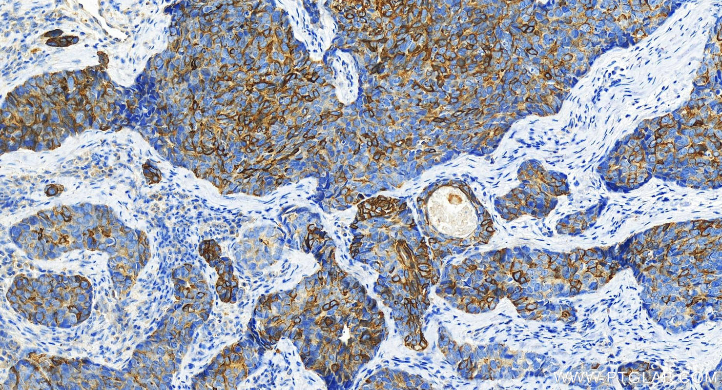 Immunohistochemistry (IHC) staining of human bowen disease using Cytokeratin 17-Specific Polyclonal antibody (17516-1-AP)