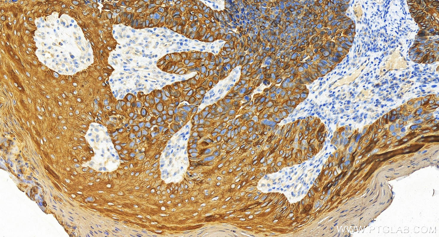 Immunohistochemistry (IHC) staining of human bowen disease using Cytokeratin 17-Specific Polyclonal antibody (17516-1-AP)