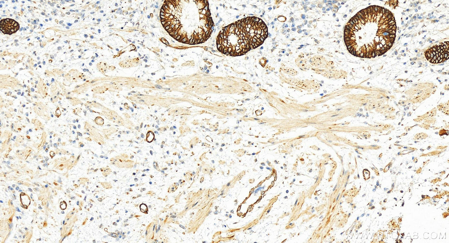 Immunohistochemistry (IHC) staining of human colon cancer tissue using Cytokeratin 18 Polyclonal antibody (10830-1-AP)