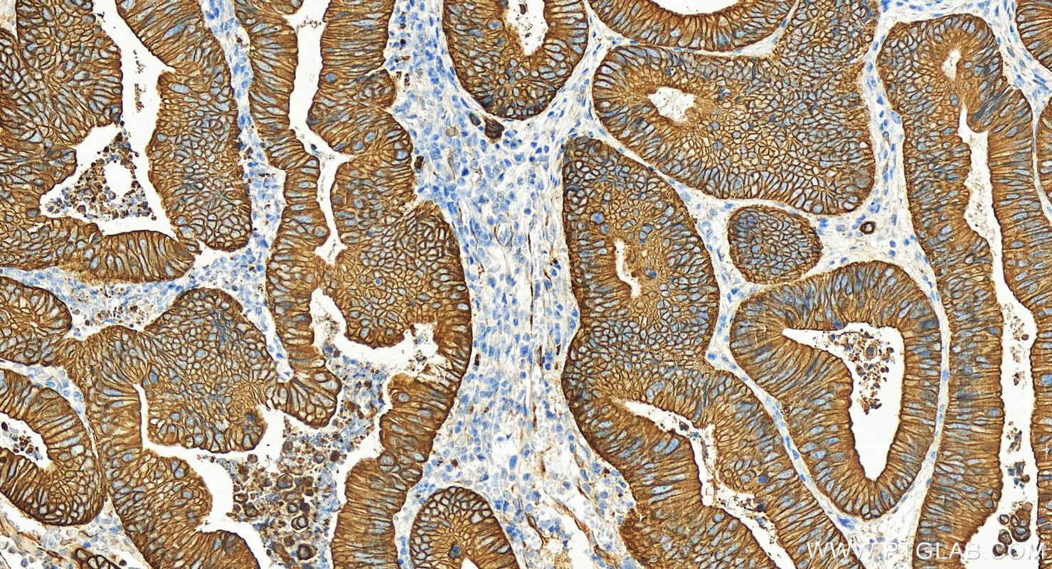 Immunohistochemistry (IHC) staining of human colon cancer tissue using Cytokeratin 18 Polyclonal antibody (10830-1-AP)