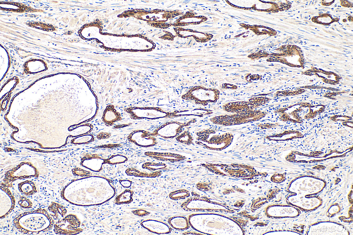 Immunohistochemistry (IHC) staining of human prostate hyperplasia tissue using Cytokeratin 18 Polyclonal antibody (10830-1-AP)