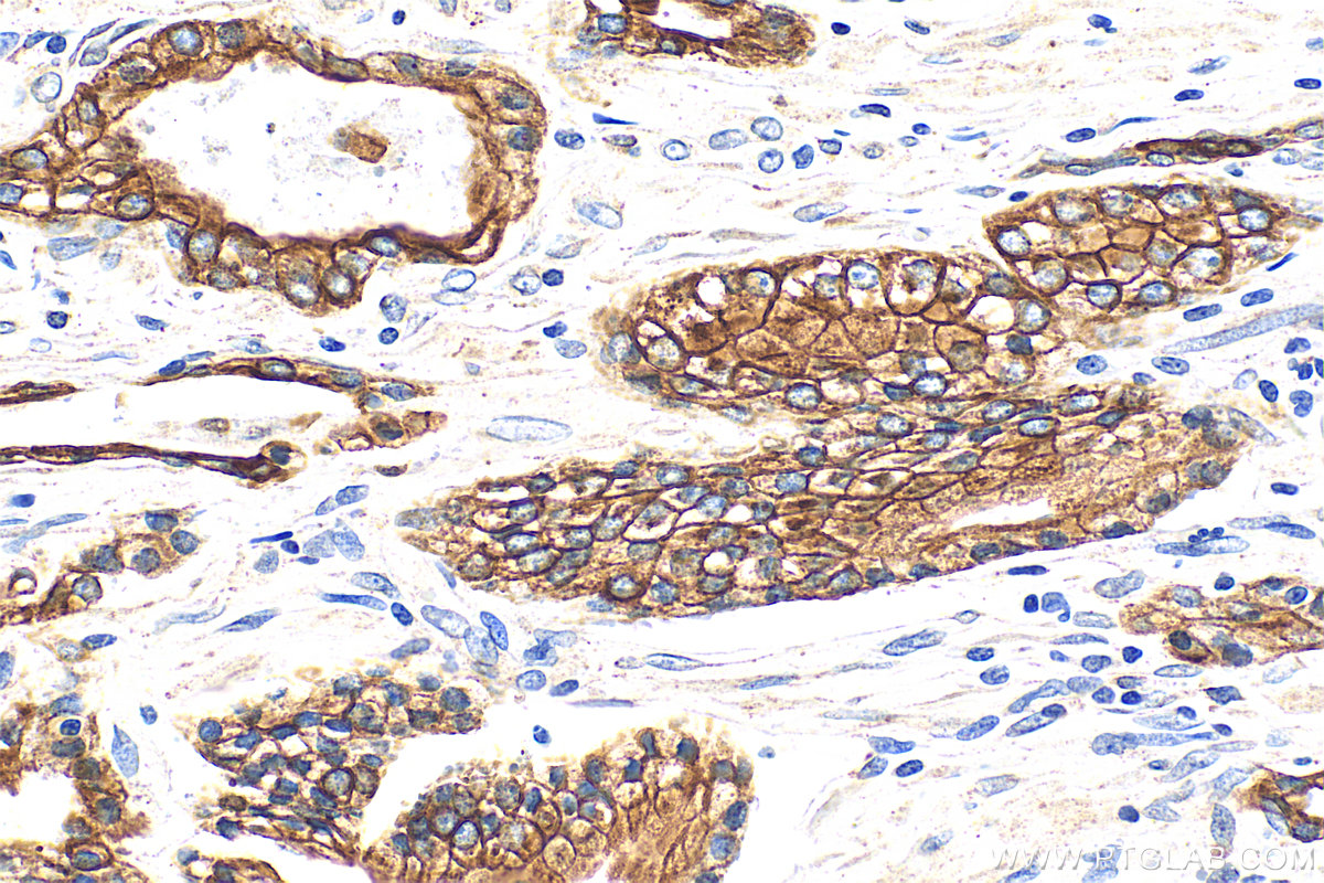 Immunohistochemistry (IHC) staining of human prostate hyperplasia tissue using Cytokeratin 18 Polyclonal antibody (10830-1-AP)