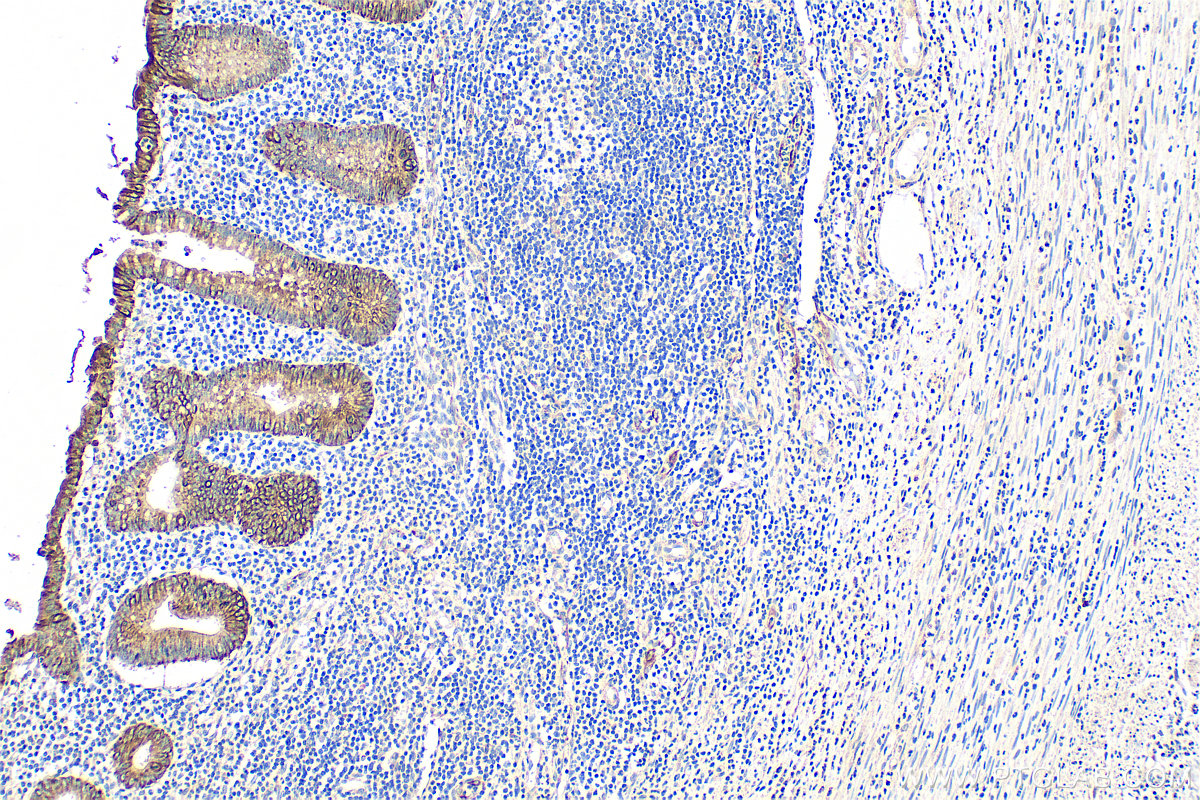 Immunohistochemistry (IHC) staining of human appendicitis tissue using Cytokeratin 18 Polyclonal antibody (10830-1-AP)