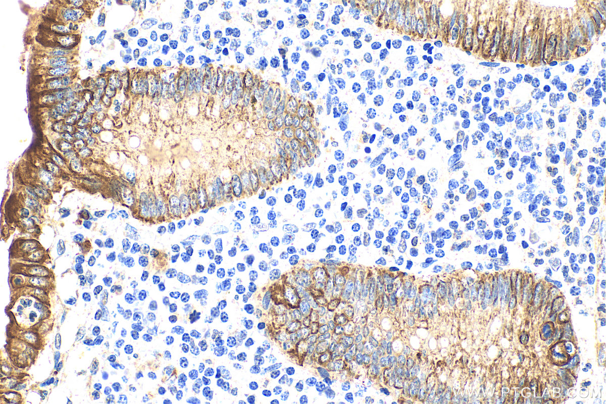 Immunohistochemistry (IHC) staining of human appendicitis tissue using Cytokeratin 18 Polyclonal antibody (10830-1-AP)