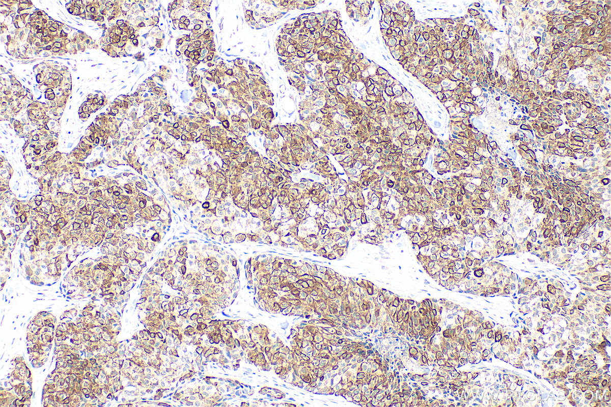 Immunohistochemistry (IHC) staining of human lung cancer tissue using Cytokeratin 18 Polyclonal antibody (10830-1-AP)