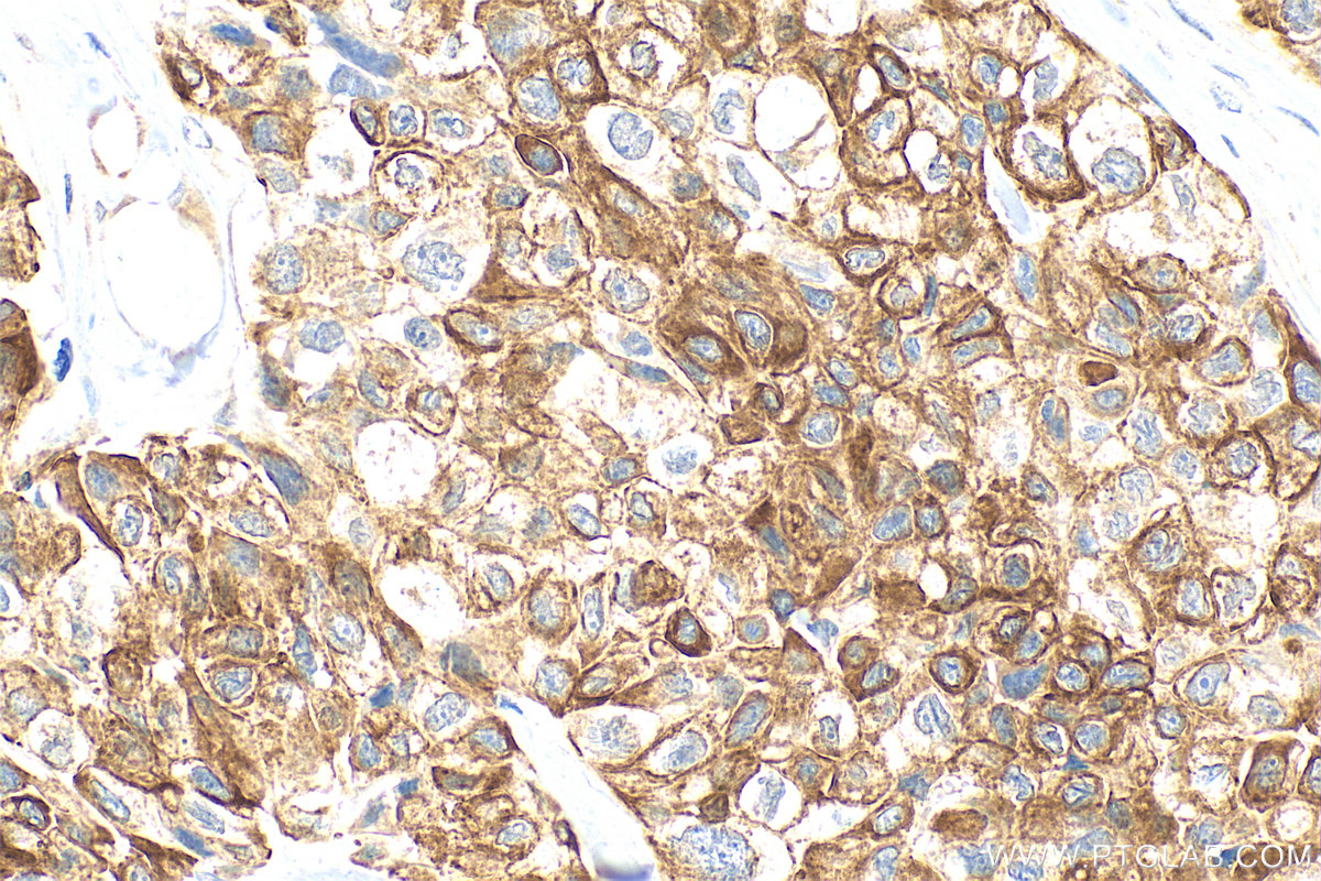 Immunohistochemistry (IHC) staining of human lung cancer tissue using Cytokeratin 18 Polyclonal antibody (10830-1-AP)