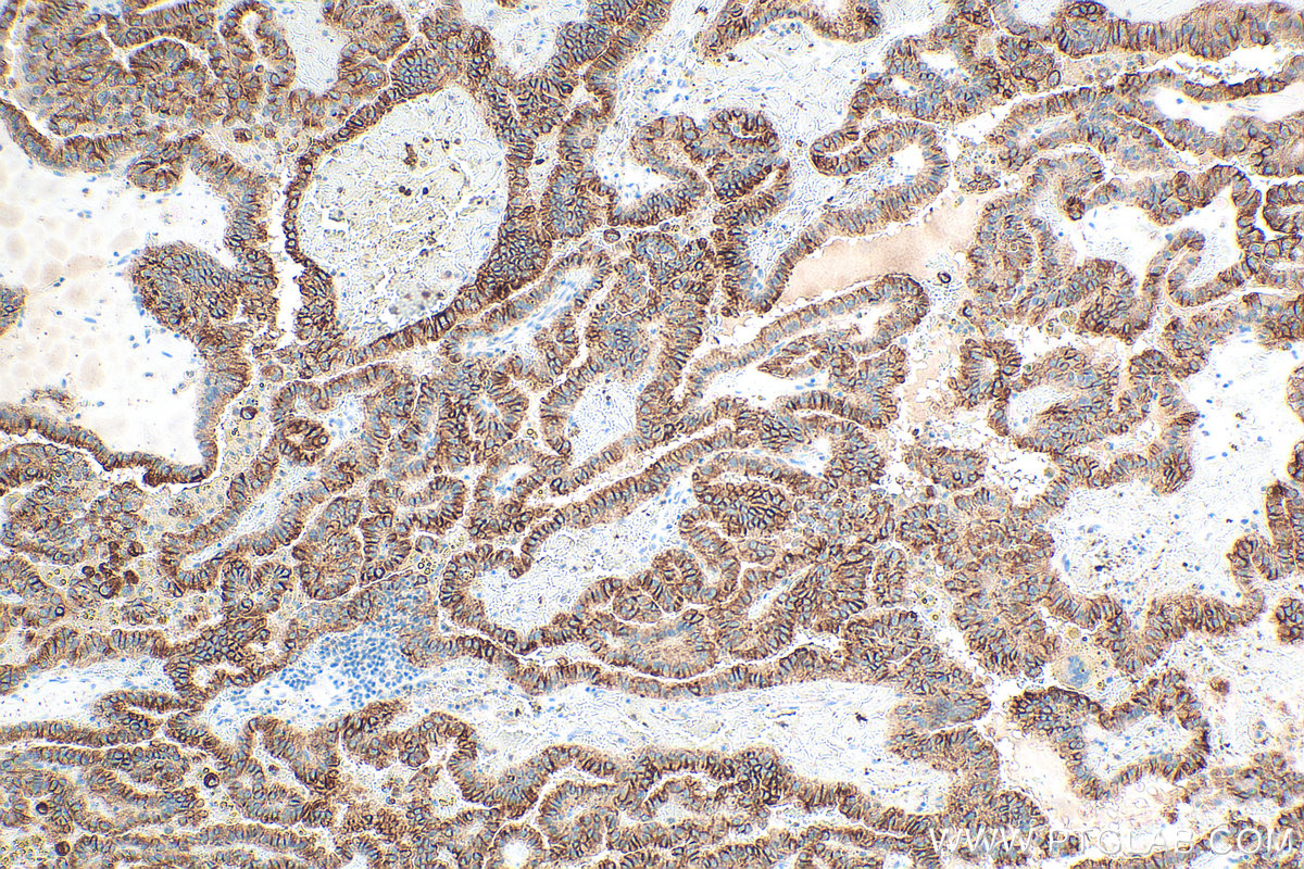 Immunohistochemistry (IHC) staining of human renal cell carcinoma tissue using Cytokeratin 18 Polyclonal antibody (10830-1-AP)