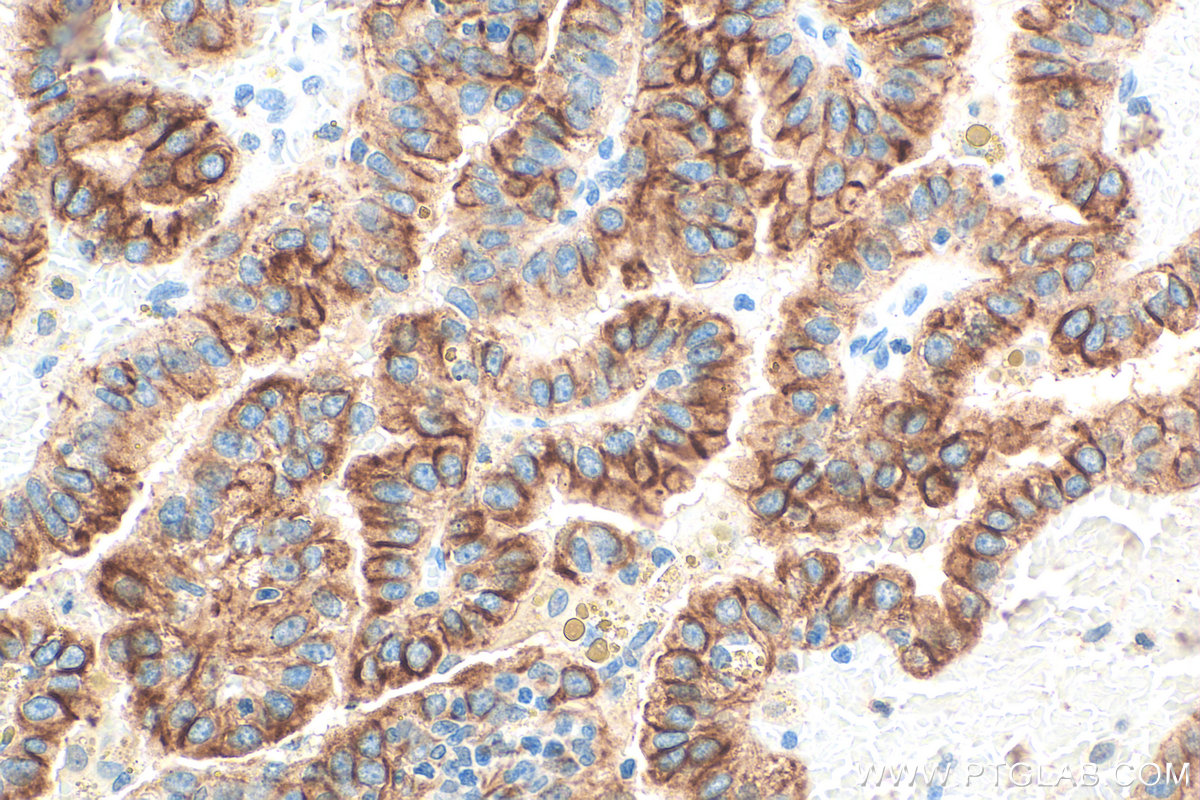 Immunohistochemistry (IHC) staining of human renal cell carcinoma tissue using Cytokeratin 18 Polyclonal antibody (10830-1-AP)