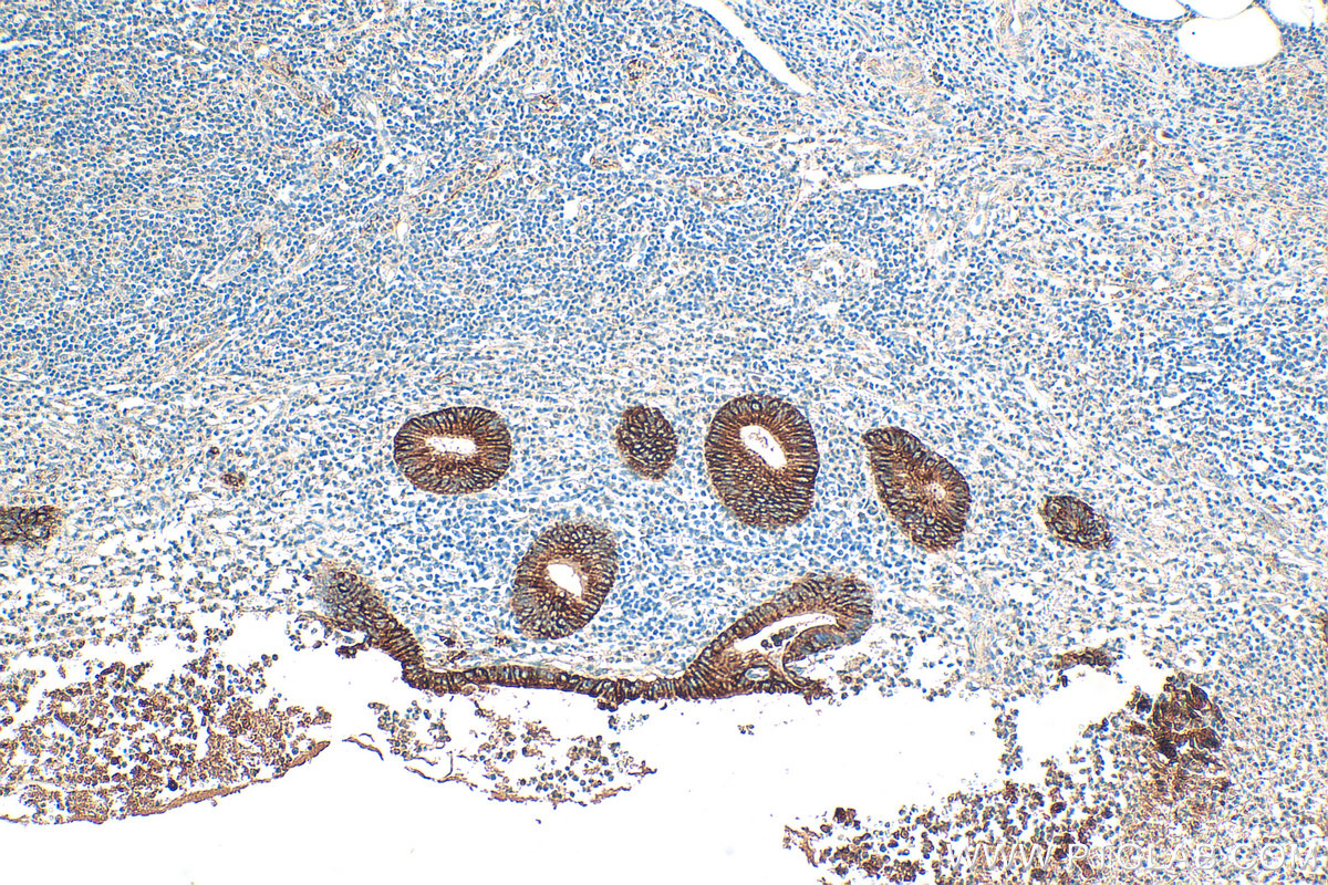 Immunohistochemistry (IHC) staining of human appendicitis tissue using Cytokeratin 18 Polyclonal antibody (10830-1-AP)