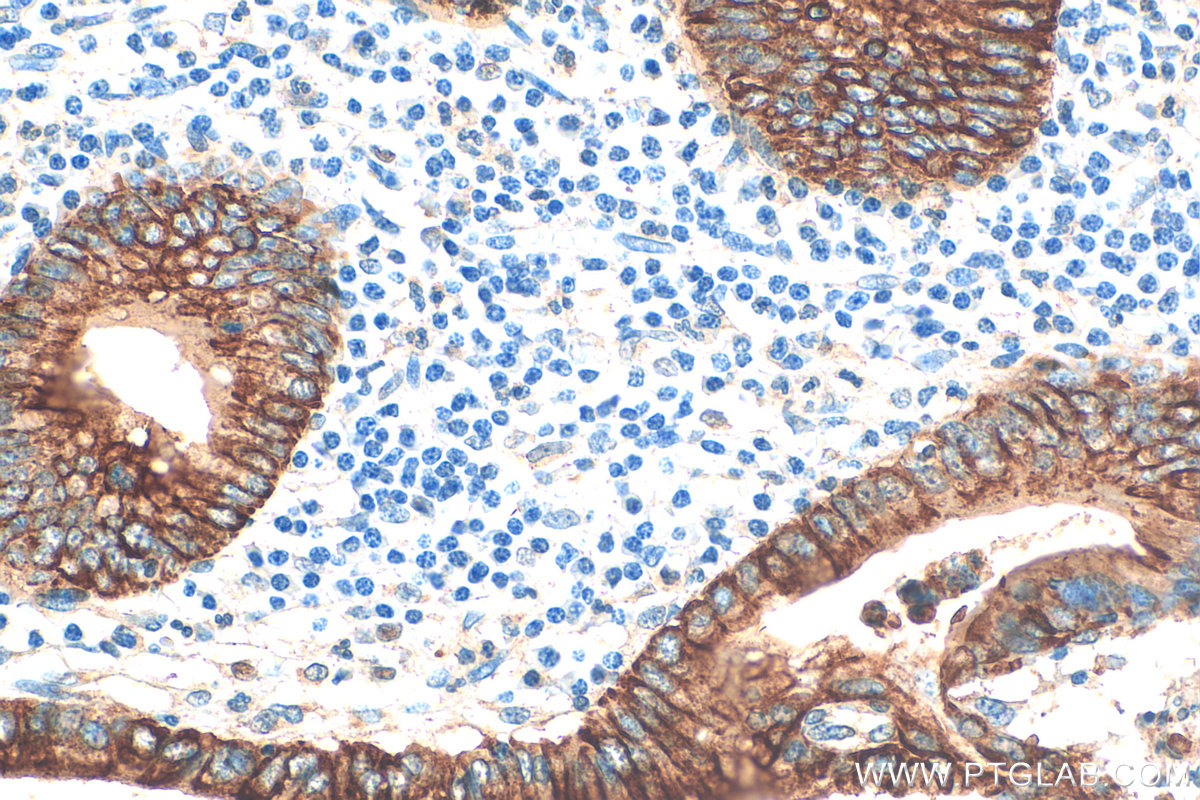 Immunohistochemistry (IHC) staining of human appendicitis tissue using Cytokeratin 18 Polyclonal antibody (10830-1-AP)