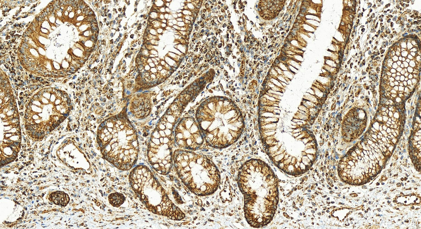 Immunohistochemistry (IHC) staining of human colon cancer tissue using Cytokeratin 18 Polyclonal antibody (18708-1-AP)