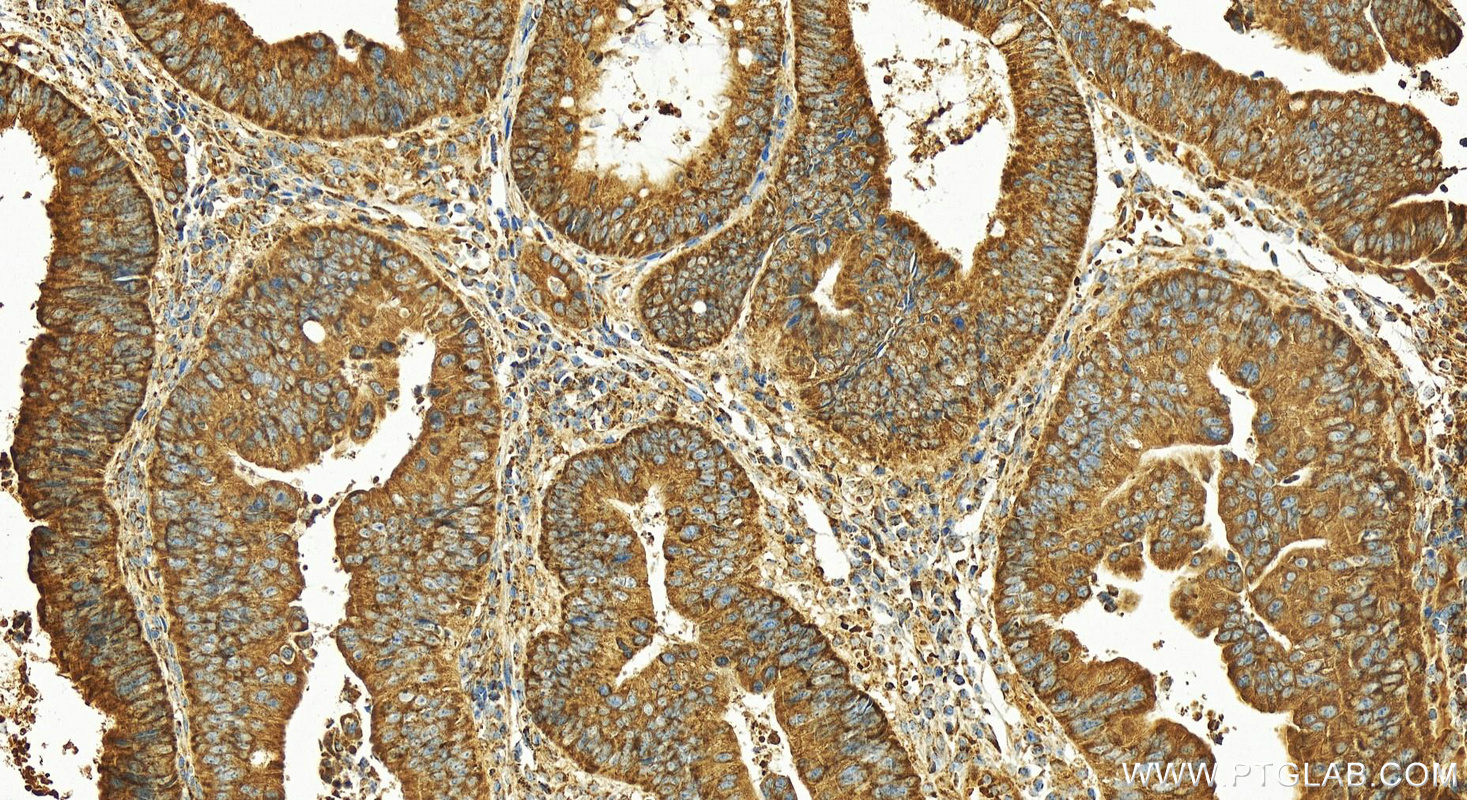 Immunohistochemistry (IHC) staining of human colon cancer tissue using Cytokeratin 18 Polyclonal antibody (18708-1-AP)