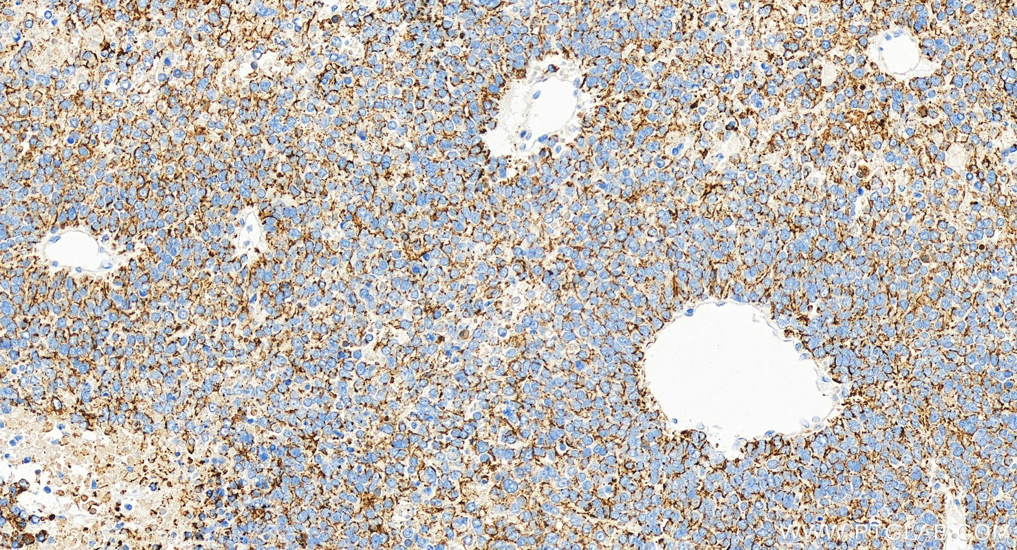 Immunohistochemistry (IHC) staining of human hepatocellular carcinoma using Cytokeratin 18 Monoclonal antibody (66187-1-Ig)