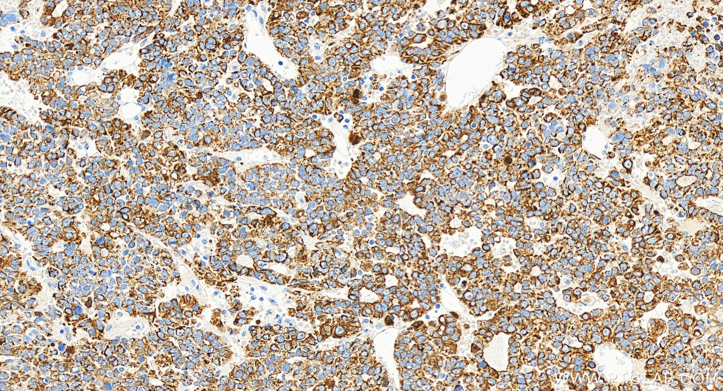 Immunohistochemistry (IHC) staining of human hepatocellular carcinoma using Cytokeratin 18 Monoclonal antibody (66187-1-Ig)