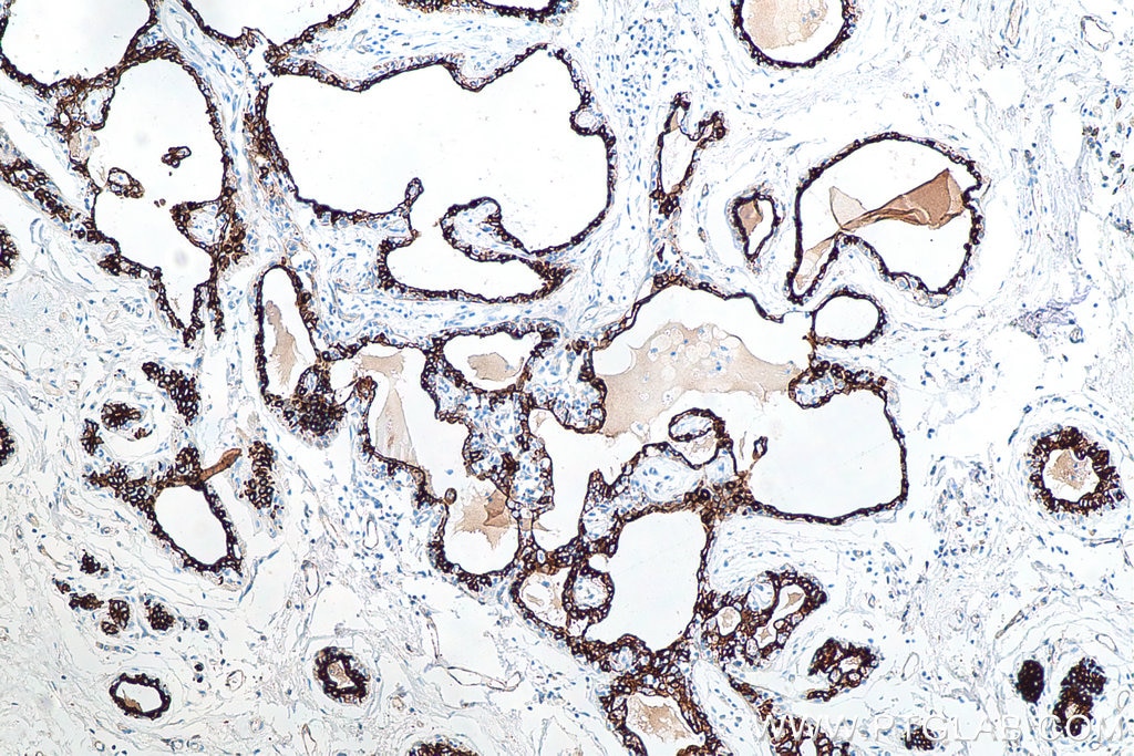 Immunohistochemistry (IHC) staining of human breast cancer tissue using Cytokeratin 18 Monoclonal antibody (66187-1-Ig)