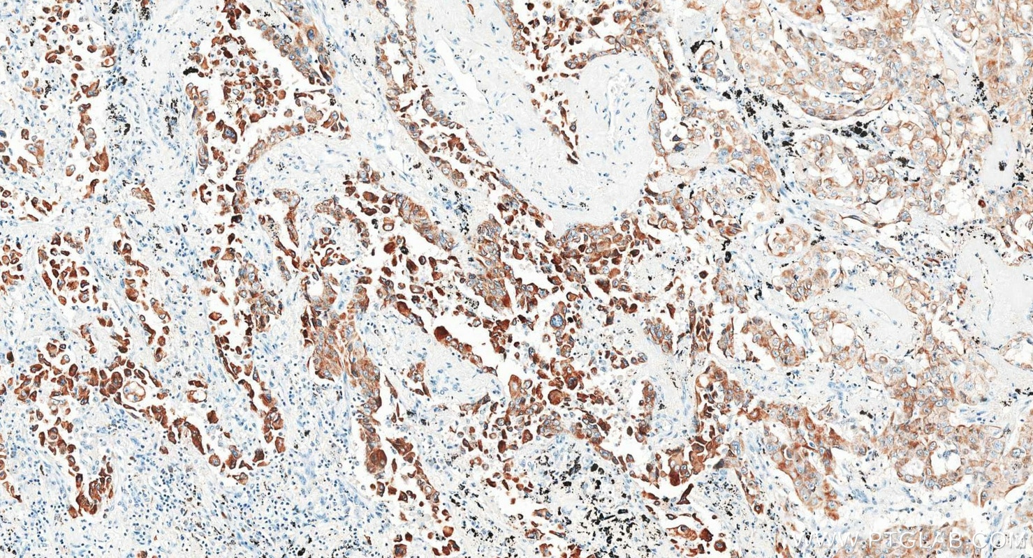 Immunohistochemistry (IHC) staining of human lung cancer tissue using Cytokeratin 18 Monoclonal antibody (66187-1-Ig)
