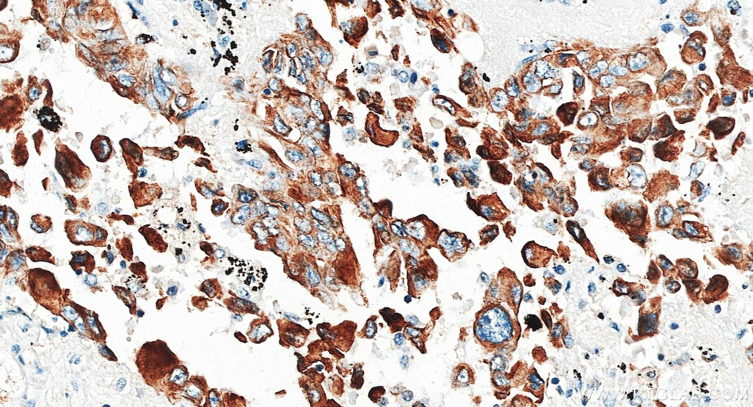 Immunohistochemistry (IHC) staining of human lung cancer tissue using Cytokeratin 18 Monoclonal antibody (66187-1-Ig)
