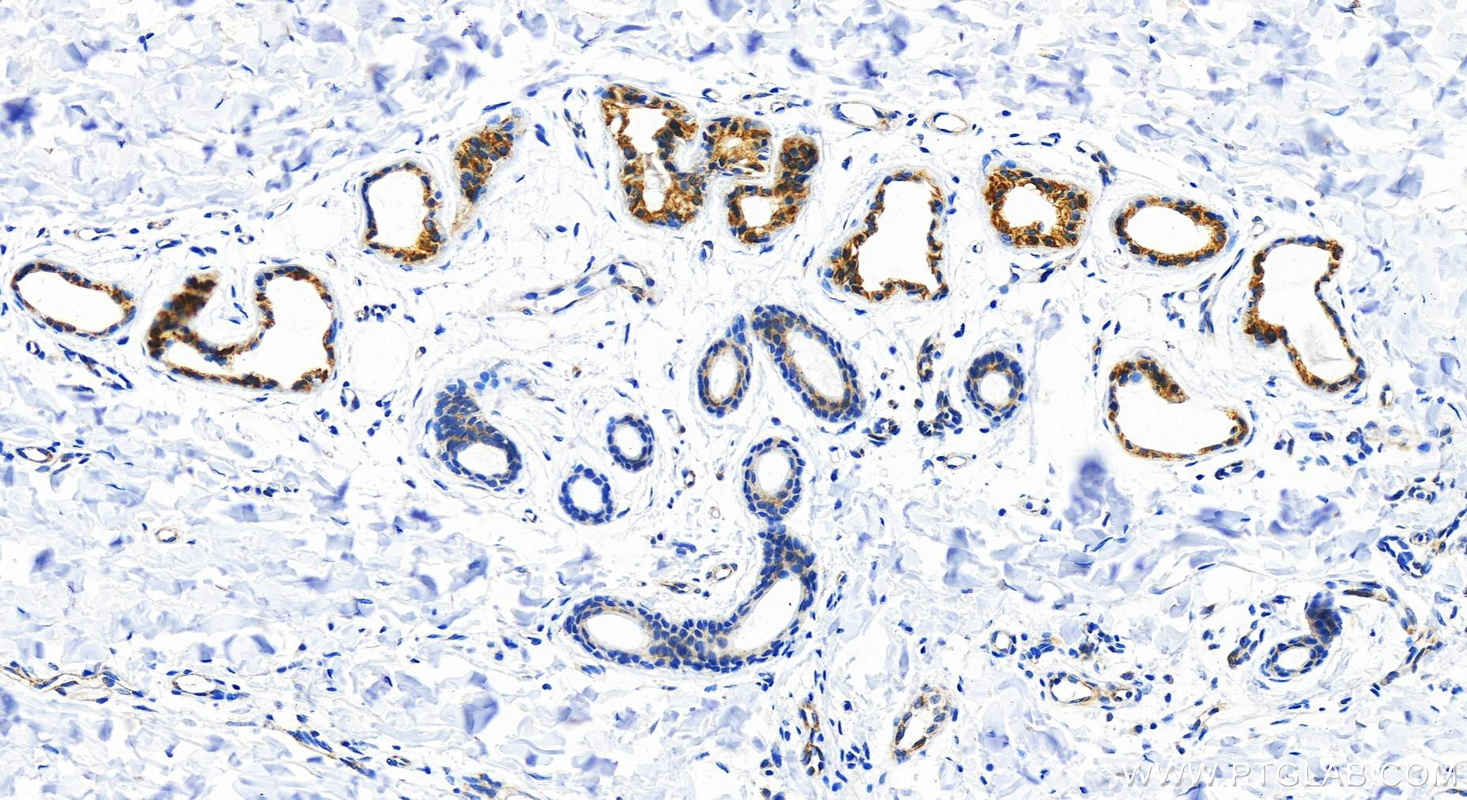 Immunohistochemistry (IHC) staining of Human bowens disease using Cytokeratin 18 Recombinant antibody (82817-5-RR)