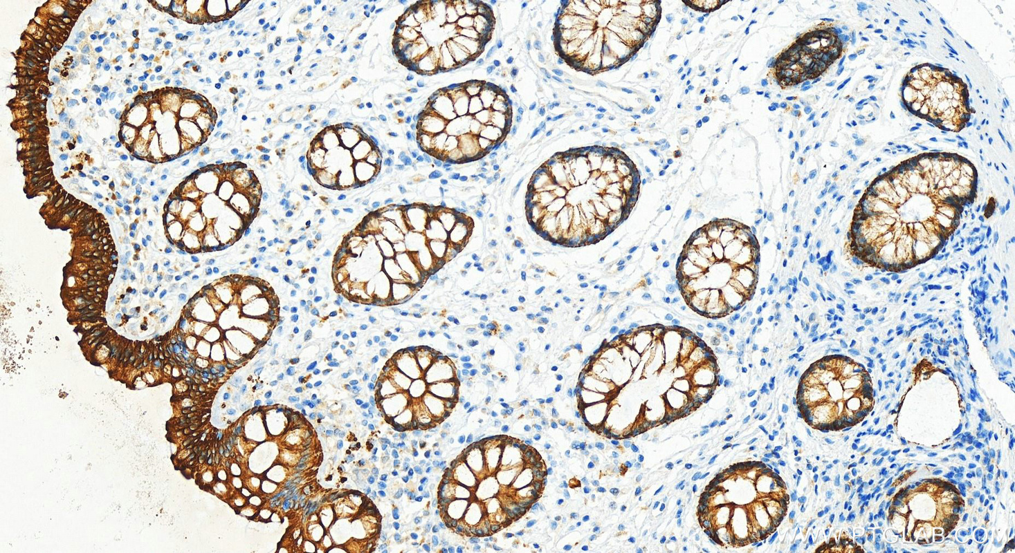 Immunohistochemistry (IHC) staining of human colon tissue using Cytokeratin 19 Polyclonal antibody (10712-1-AP)