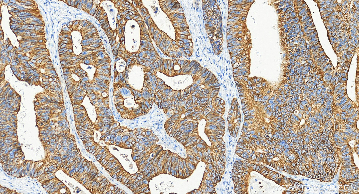 Immunohistochemistry (IHC) staining of human colon cancer tissue using Cytokeratin 19 Polyclonal antibody (10712-1-AP)