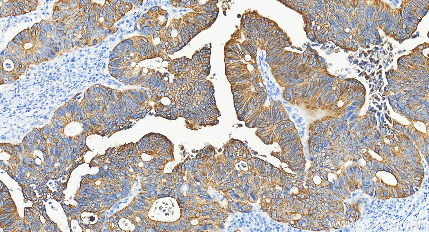 Immunohistochemistry (IHC) staining of human colon cancer tissue using Cytokeratin 19 Polyclonal antibody (10712-1-AP)