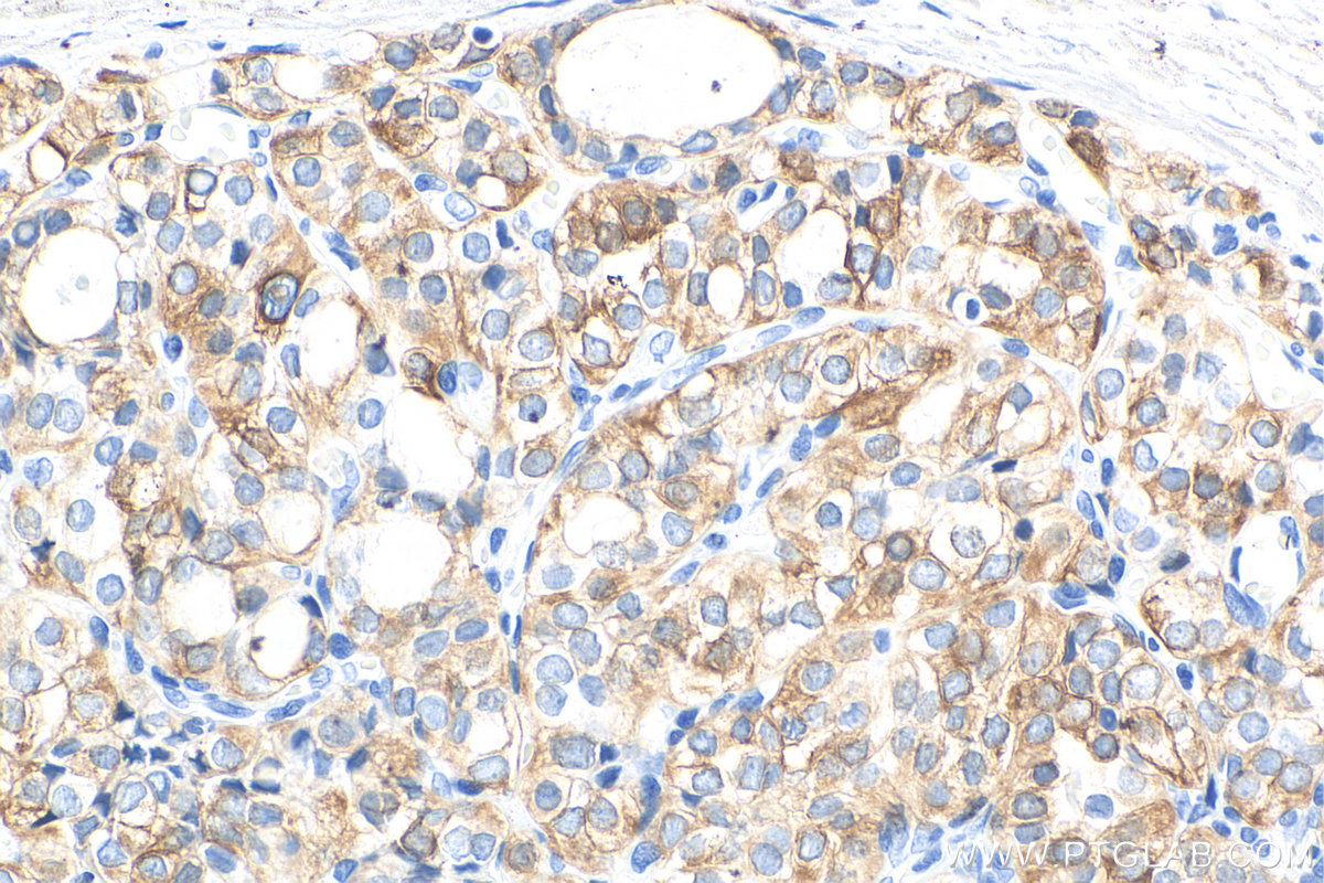 Immunohistochemistry (IHC) staining of human thyroid cancer tissue using Cytokeratin 19 Polyclonal antibody (10712-1-AP)