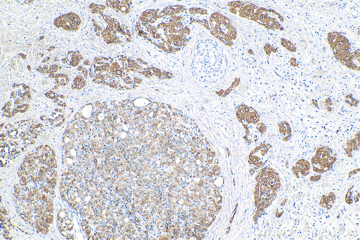 Immunohistochemistry (IHC) staining of human thyroid cancer tissue using Cytokeratin 19 Polyclonal antibody (10712-1-AP)