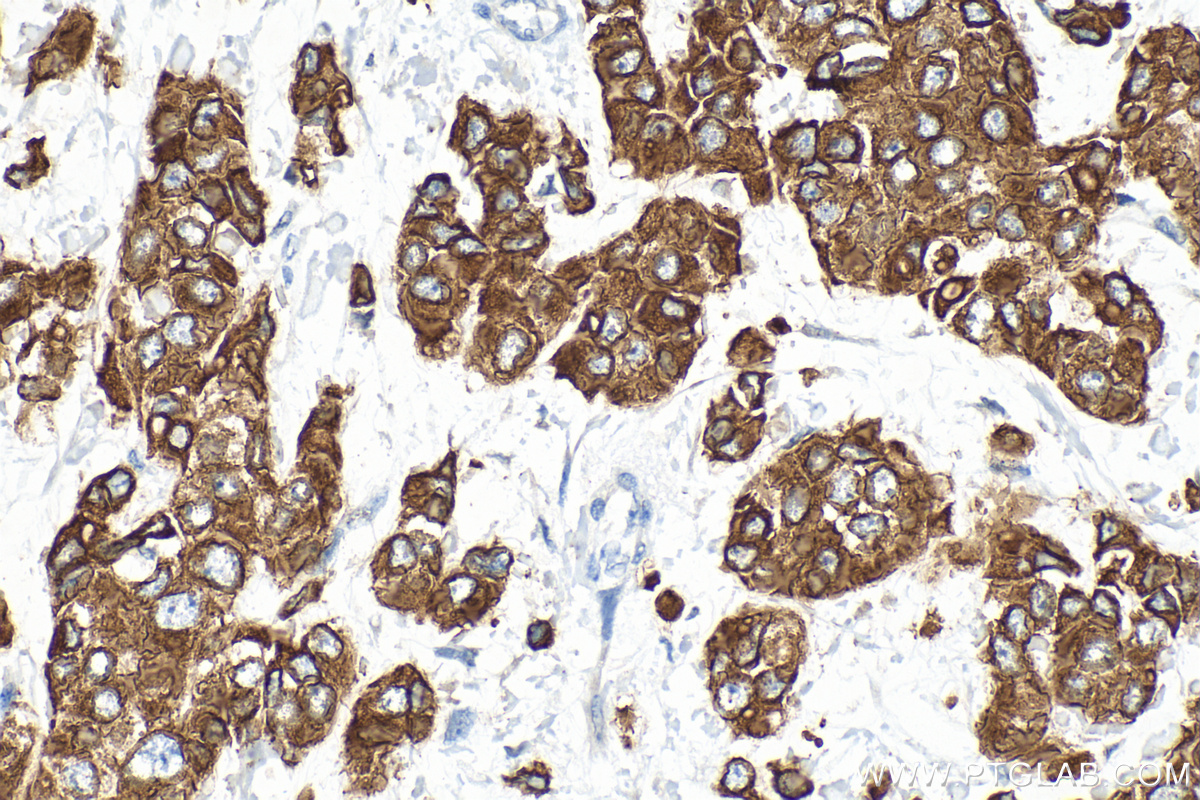 Immunohistochemistry (IHC) staining of human breast cancer tissue using Cytokeratin 19 Polyclonal antibody (14965-1-AP)