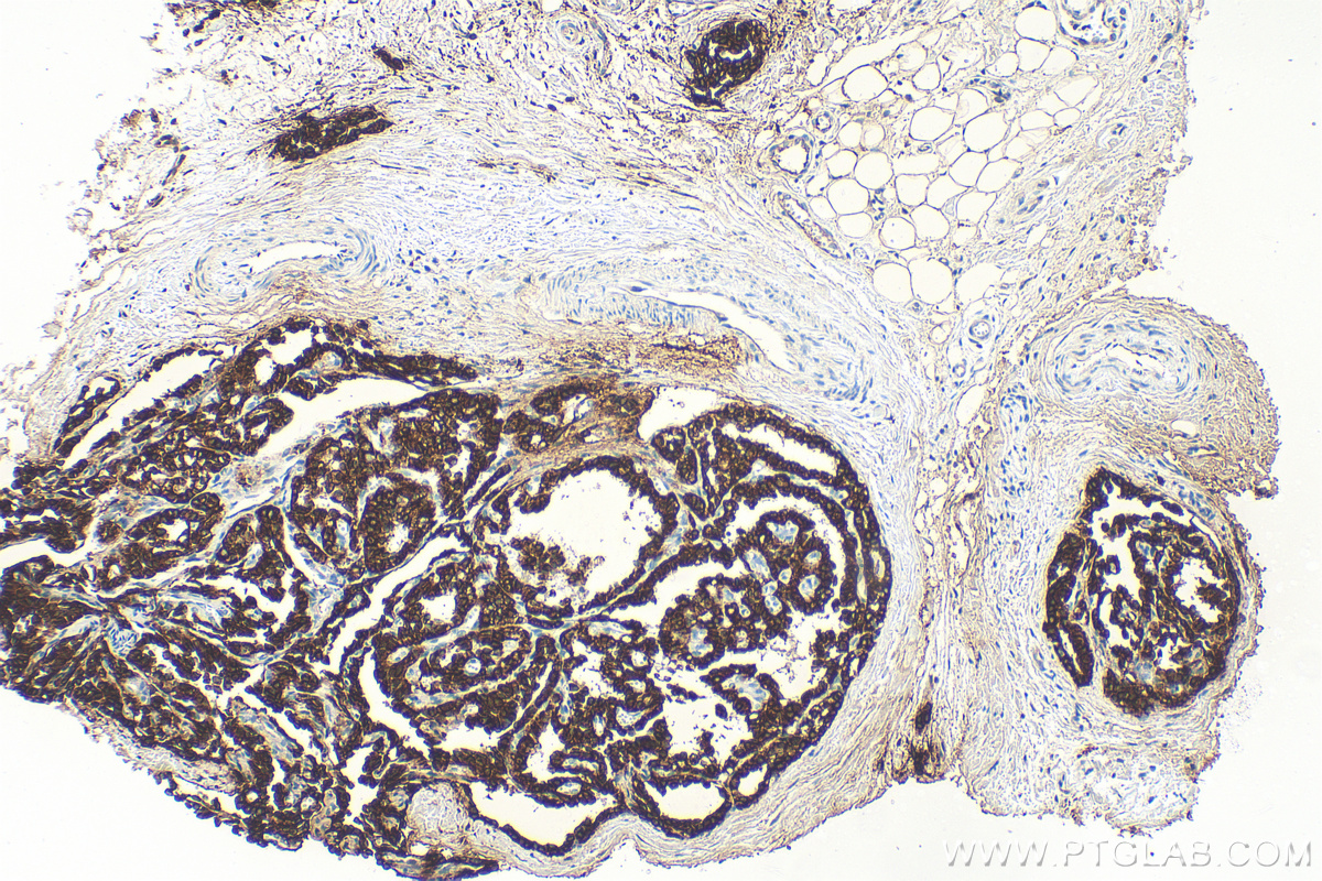Immunohistochemistry (IHC) staining of human thyroid cancer tissue using Cytokeratin 19 Polyclonal antibody (14965-1-AP)