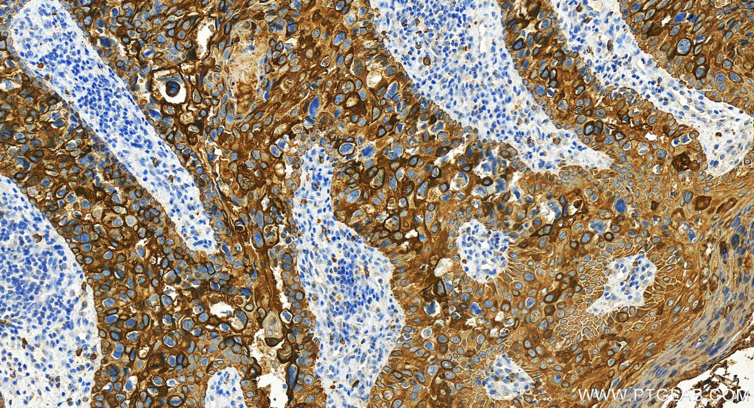 Immunohistochemistry (IHC) staining of human brown disease using Cytokeratin 19 Polyclonal antibody (14965-1-AP)