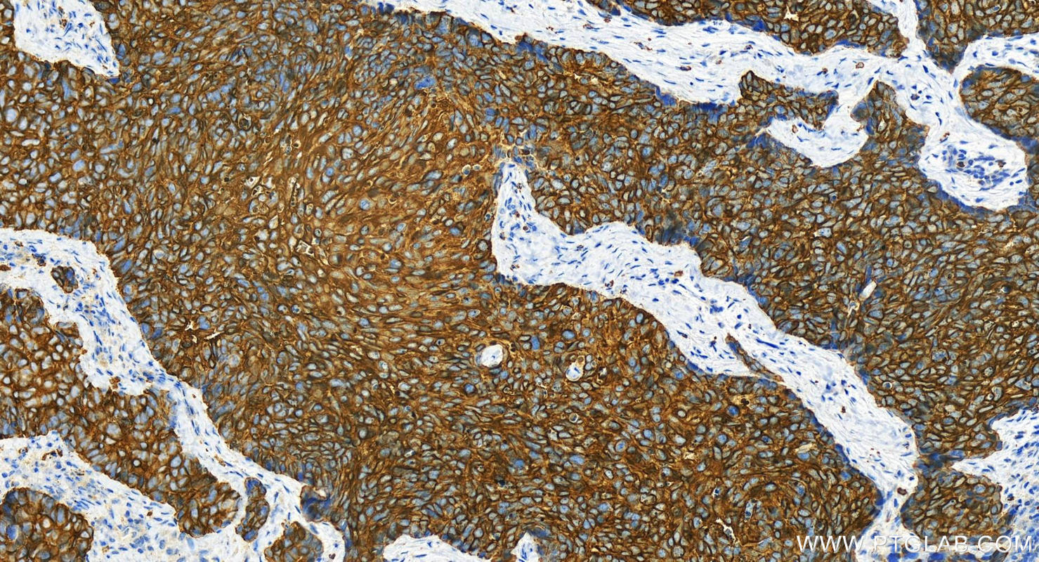 Immunohistochemistry (IHC) staining of human brown disease using Cytokeratin 19 Polyclonal antibody (14965-1-AP)