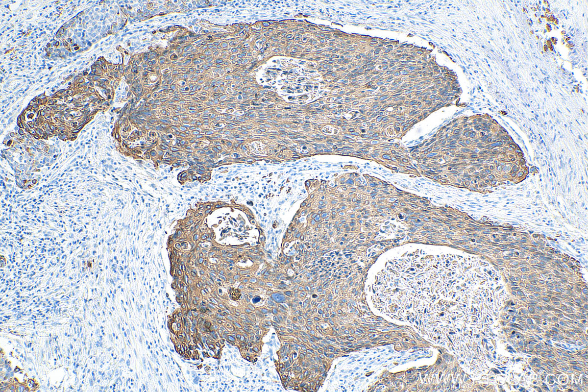 Immunohistochemistry (IHC) staining of human oesophagus cancer tissue using Cytokeratin 19 Monoclonal antibody (60187-1-Ig)