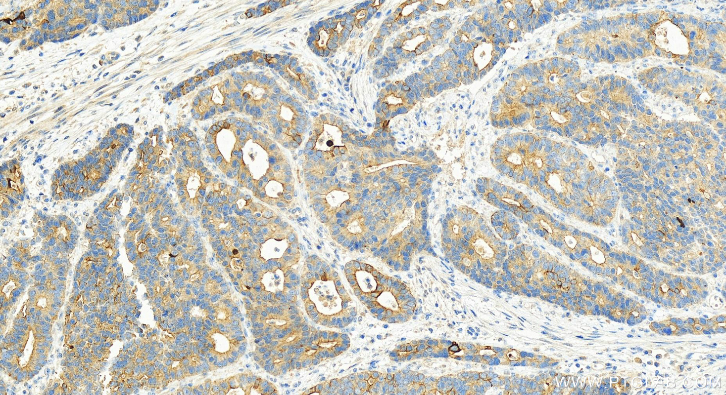 Immunohistochemistry (IHC) staining of human stomach cancer tissue using Cytokeratin 20 Polyclonal antibody (17329-1-AP)