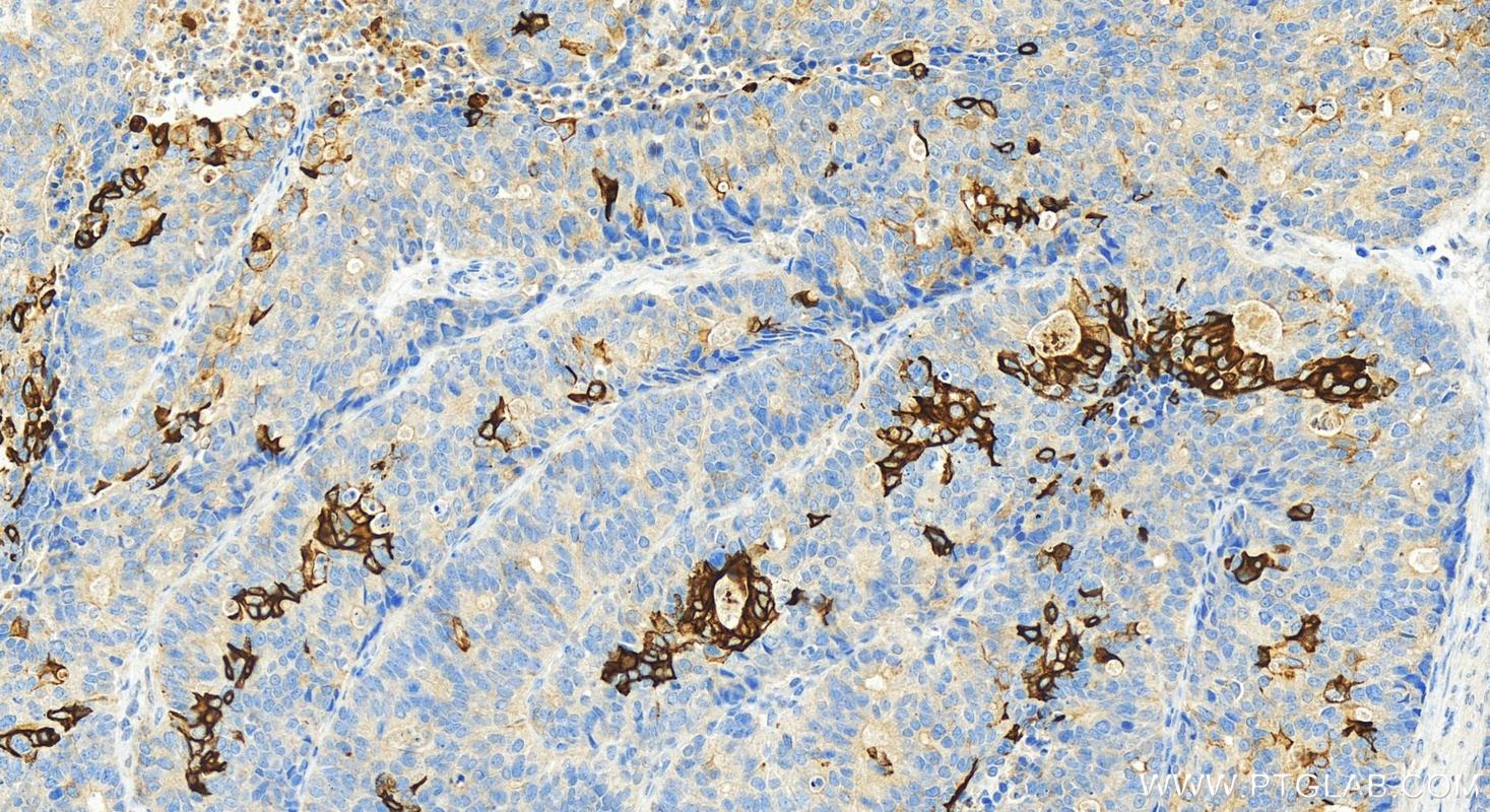 Immunohistochemistry (IHC) staining of human stomach cancer tissue using Cytokeratin 20 Polyclonal antibody (17329-1-AP)