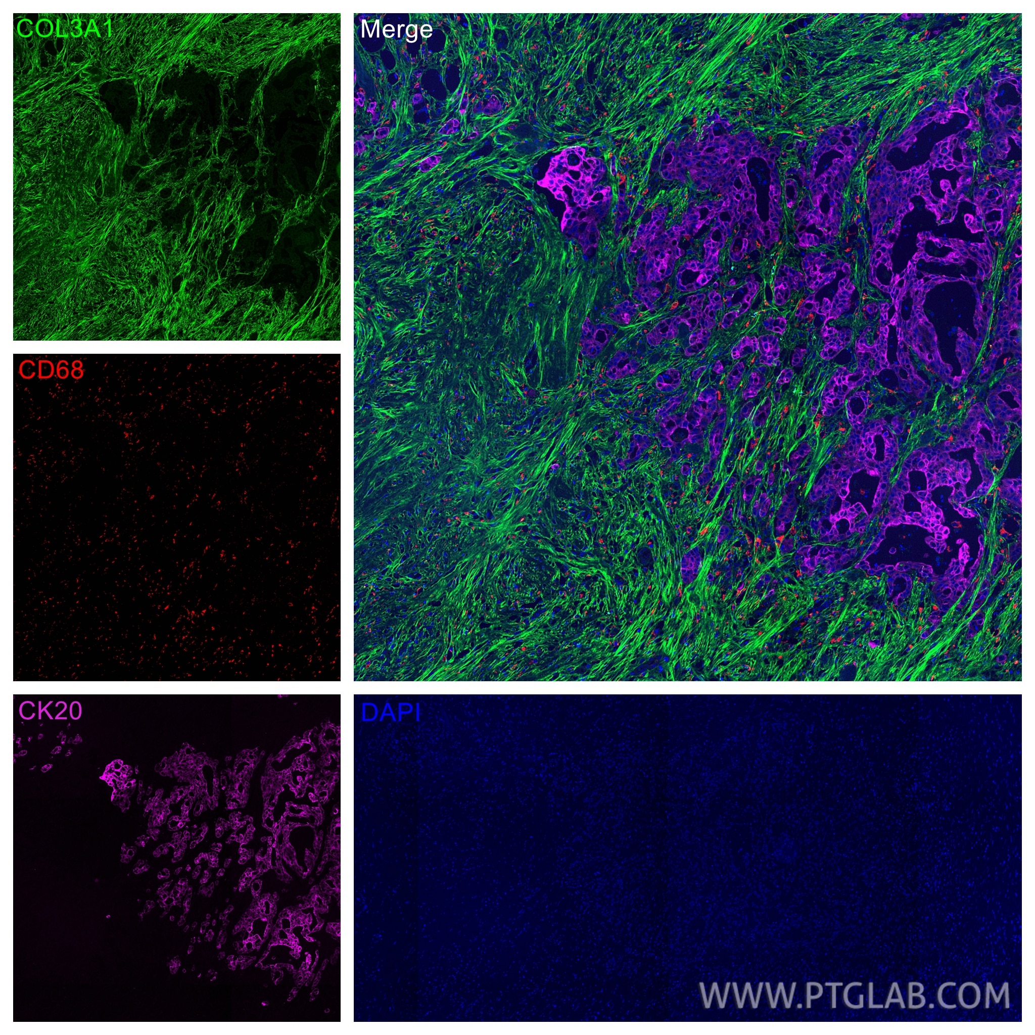 Immunofluorescence (IF) / fluorescent staining of human colon cancer tissue using Cytokeratin 20 Polyclonal antibody (17329-1-AP)