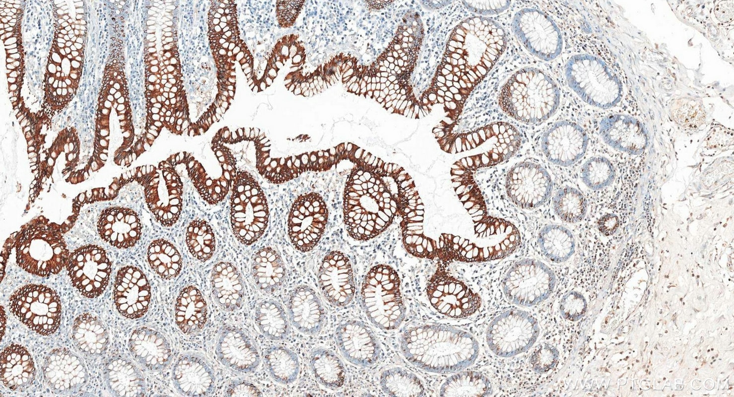 Immunohistochemistry (IHC) staining of human colon tissue using Cytokeratin 20 Polyclonal antibody (17329-1-AP)