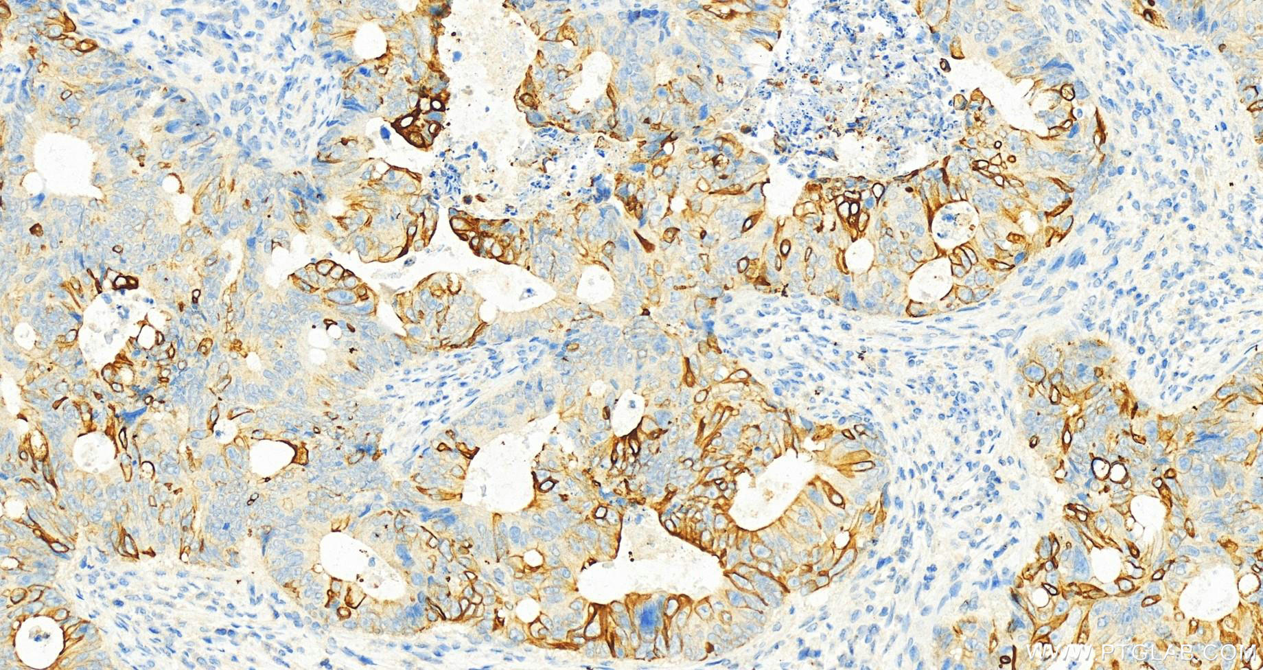 Immunohistochemistry (IHC) staining of human colon cancer tissue using Cytokeratin 20 Monoclonal antibody (60183-1-Ig)