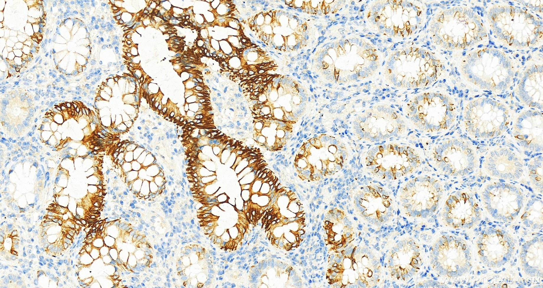 Immunohistochemistry (IHC) staining of human colon cancer tissue using Cytokeratin 20 Monoclonal antibody (60183-1-Ig)